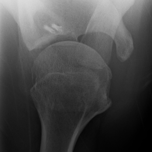 Failed Open Stabilisation Lateral